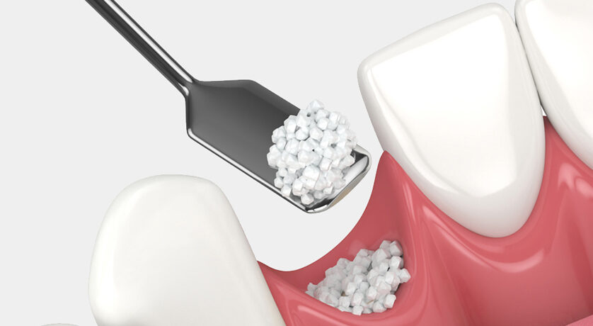 Bone Grafting