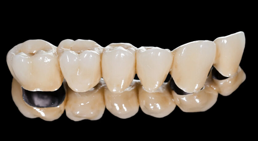 Dental Bridges