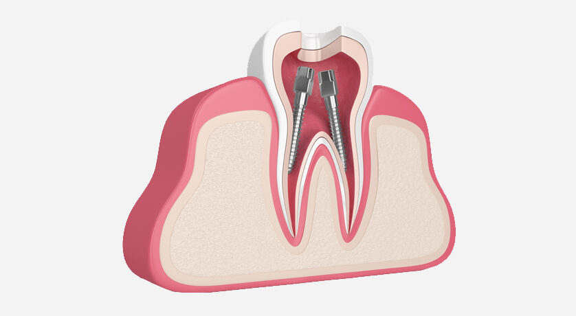 Root Canal Therapy